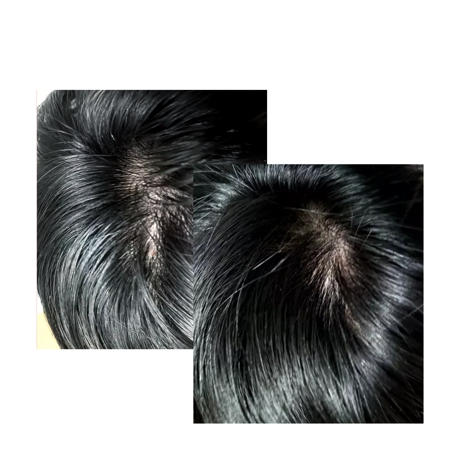  before and after hair scalp improvement