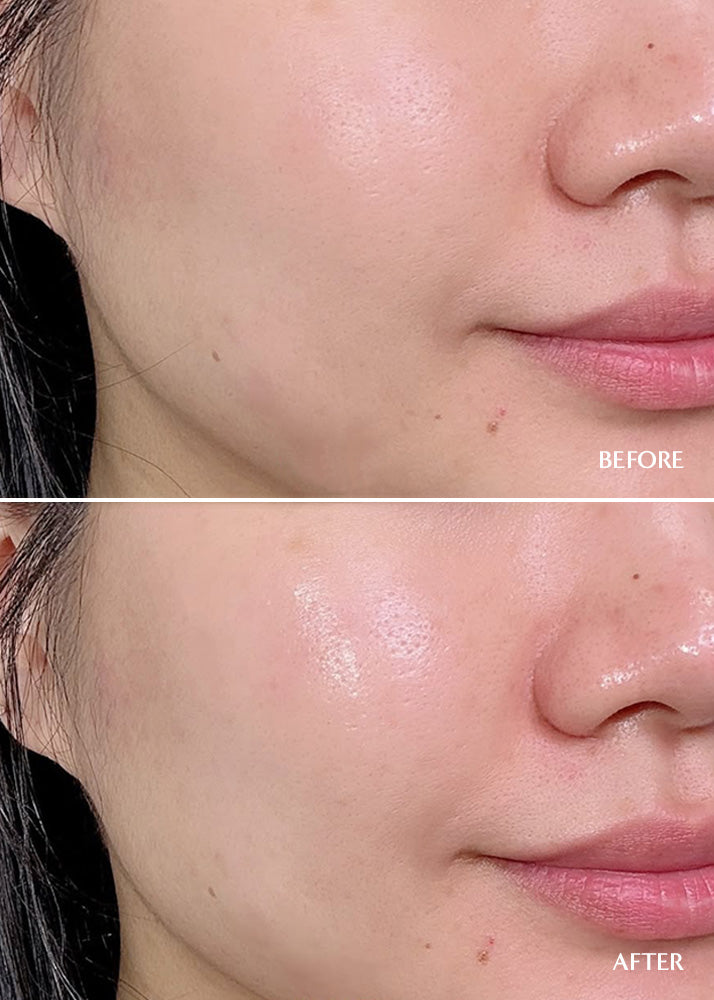 Before and after comparison of a person's face with visible skin improvement.